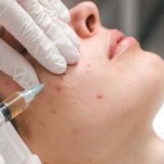 A close-up of a dermatological procedure with a medical professional injecting treatment into the acne-affected skin of a patient.